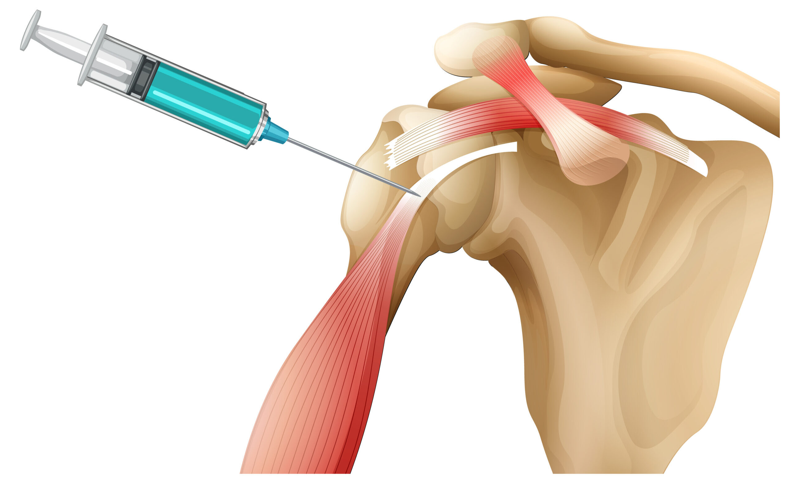 Frozen Shoulder Doctor in Kolkata